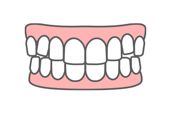 叢生（デコボコ）