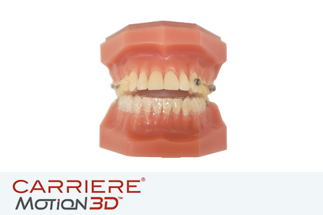 カリエール（CARRIERE）出っ歯や反対咬合（受け口）の症状が出ている方に適した治療装置