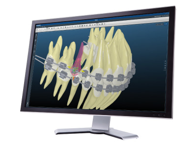 見えにくい矯正