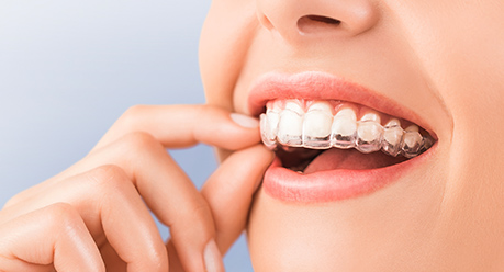 マウスピース矯正